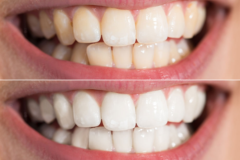 3 Teeth Whitening Procedures