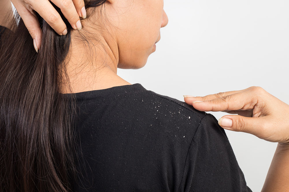 5 Effective Home Remedies for Dandruff