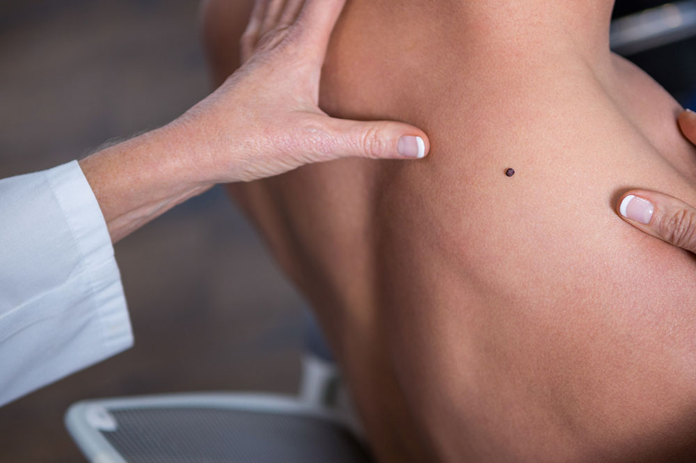 5 Warning Signs of Melanoma